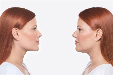 Double chin or submental fullness — True Skin Cosmetic & Laser Clinic