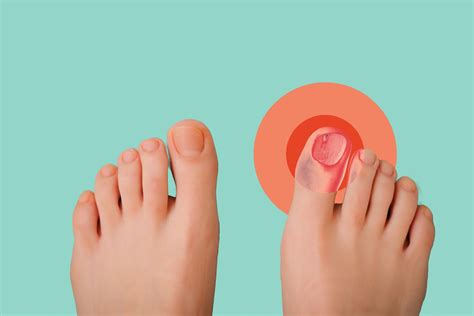 Ingrown Toenail: Symptoms, Causes, Treatment, and Prevention