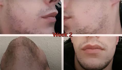 Minoxidil Before And After Beard