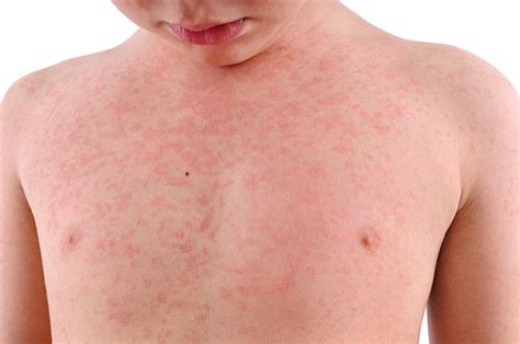 How To Get Rid Of Heat Rash | Symptoms, Treatment | - Wealth Fits