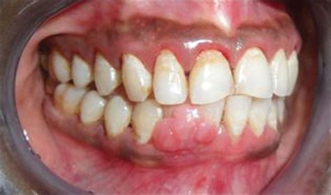 Oral Pyogenic Granuloma Causes Diagnosis Treatment, 48% OFF