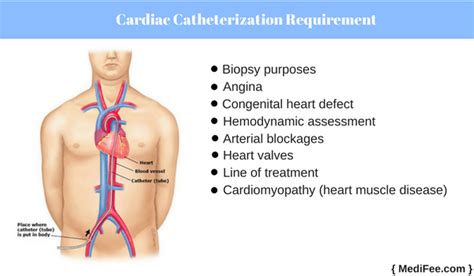 What is a cardiac catheterization surgery? Procedure and Risks