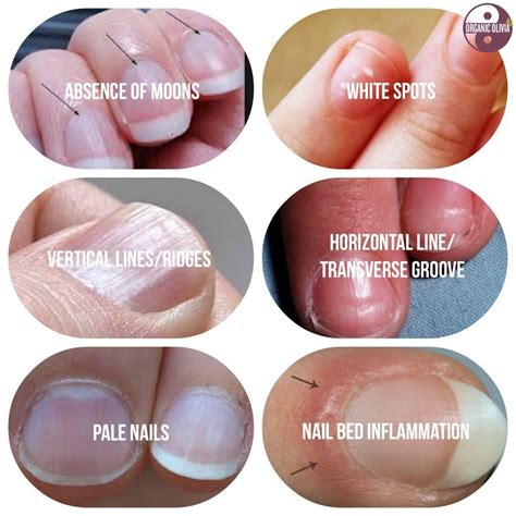 Nail Color Health Meaning