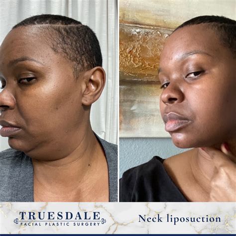 Neck (Submental) Liposuction Gallery