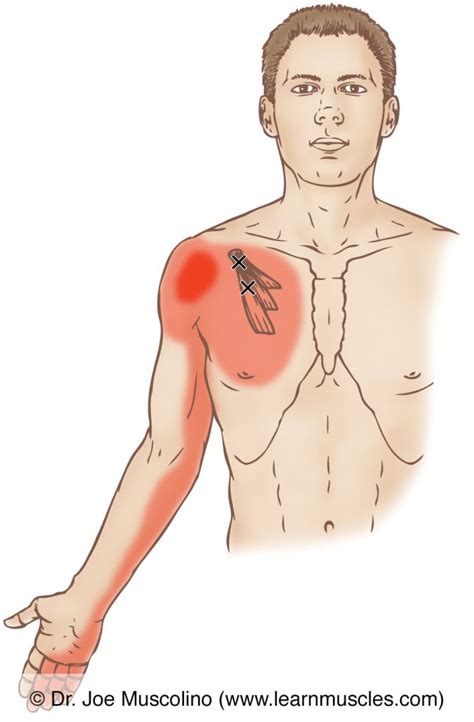 Pectoralis Minor - Trigger Points - Learn Muscles