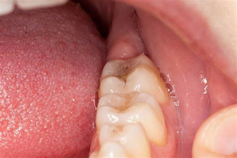 Cavity Symptoms You Shouldn’t Ignore | The Healthy