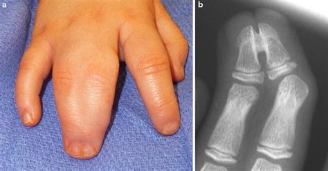 Syndactyly | Obgyn Key