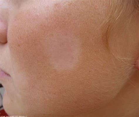 Pityriasis Alba - Pictures, Causes, Symptoms, Treatment - HubPages