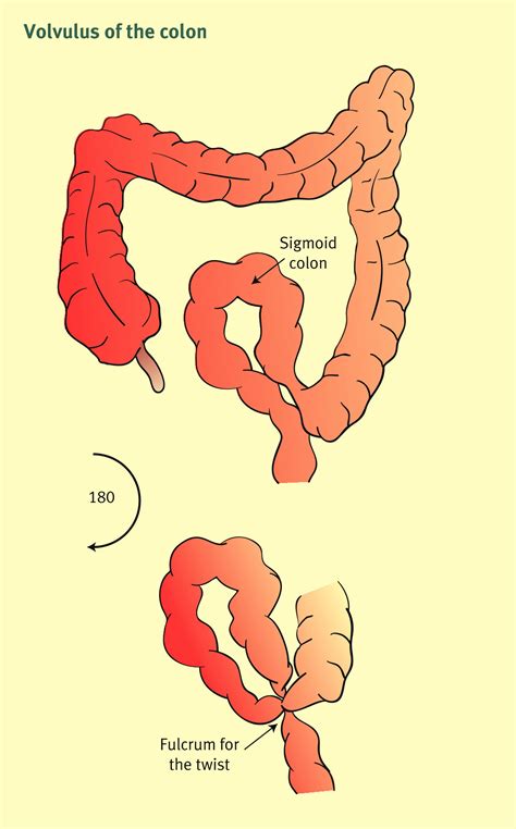 References in Sigmoid volvulus, acquired megacolon and pseudo ...