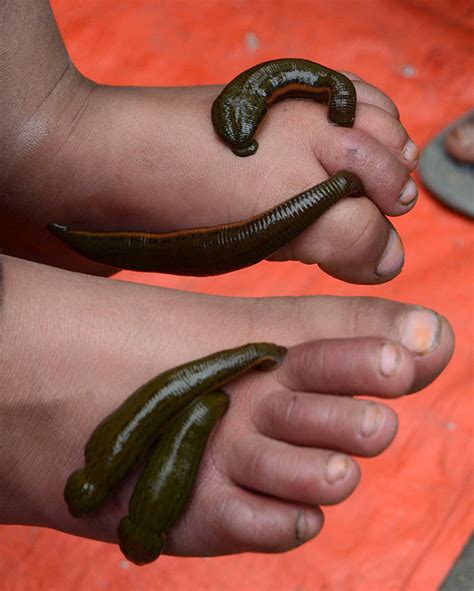 leech therapy (2) | Kashmir Life