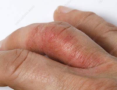 Psoriatic Arthritis on Hand - Stock Image - C036/6324 - Science Photo ...