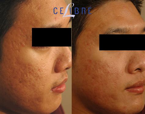 Acne Scar Removal Before and After Pictures of Actual Patients