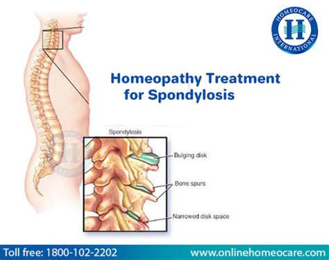 Homeopathy Treatment For Spondylosis - Health, Beauty & Fitness Service In Aminjikarai Chennai ...