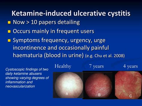 PPT - Ketamine An overview of its effects on mental and physical health ...