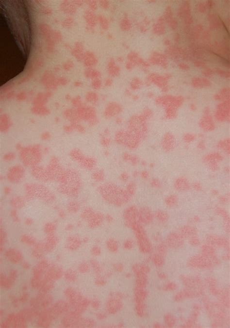 Amoxicillin Rash – Symptoms, Causes, Pictures, Treatment