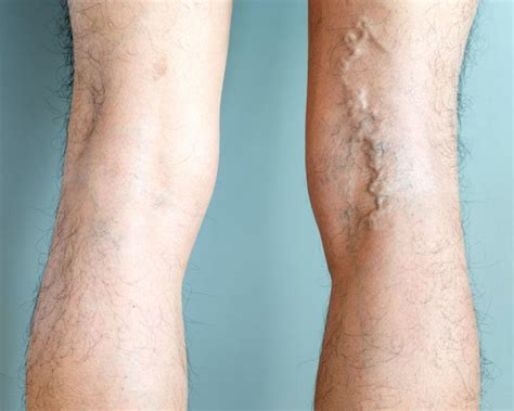 What Are the Best Ways to Treat Bulging Varicose Veins? | Blog | South Valley Vascular