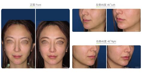 Philtrum Reduction-Facial Surgery | Wish Aesthetic Surgery Clinic