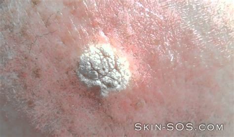 seborrheic keratosis scalp - pictures, photos