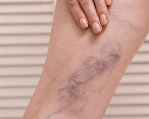 Leg Pain and Other Warning Signs of DVT Blood Clots | Blog | South Valley Vascular