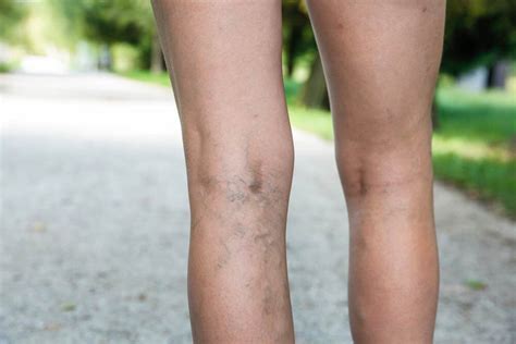 Spider Veins on Legs: Symptoms & Treatment — Physicians Vein Clinics