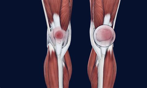 runner`s knee Archives | Osteo Health – osteopath clinic in Calgary