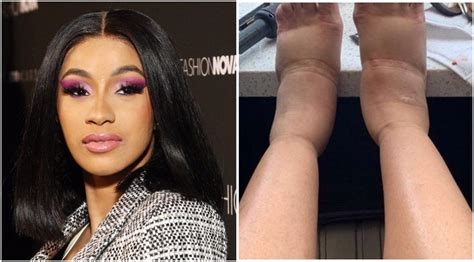 Cardi B May Have Major Damage From Plastic Surgery | Plastic surgery, Cardi b, Cardi