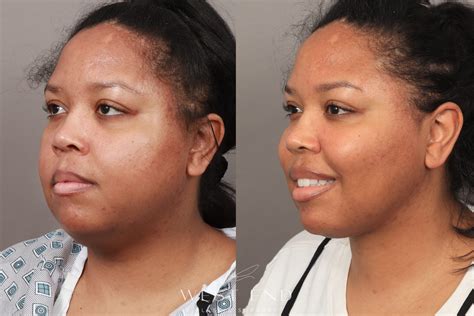 Buccal Fat Removal, Liposuction, and Renuvion Skin Tightening (1 Month Post-op) Before & After ...