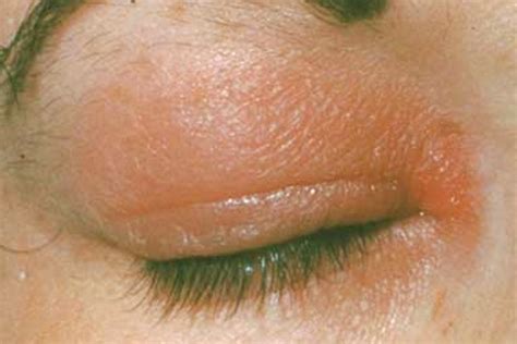 Rash On Eyelid Pictures Causes And Treatment - vrogue.co