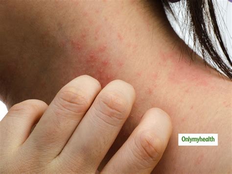 How Skin Asthma is Treated and Managed? | OnlyMyHealth