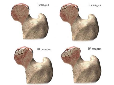 Ischemic Necrosis Of Femoral Head