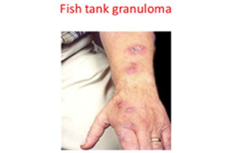 Fish Tank Granuloma