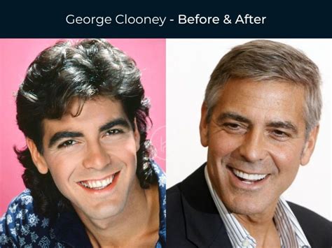 10 Celebrity Dental Implants: Before And After Images! - Dezy