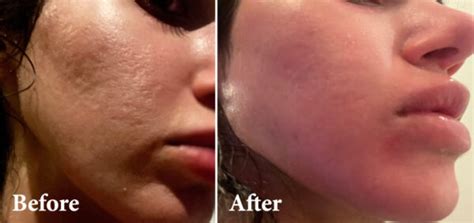 Treating Acne Scars With CO2 Laser Therapy - LMC