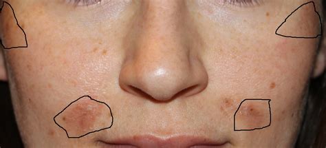 Jessner Peel Photos: A Blogger's Before & After Guide to Chemical Peels