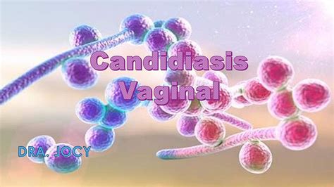 Candidiasis Vaginal en 5 min | Enfermedades | Enfermería | uDocz