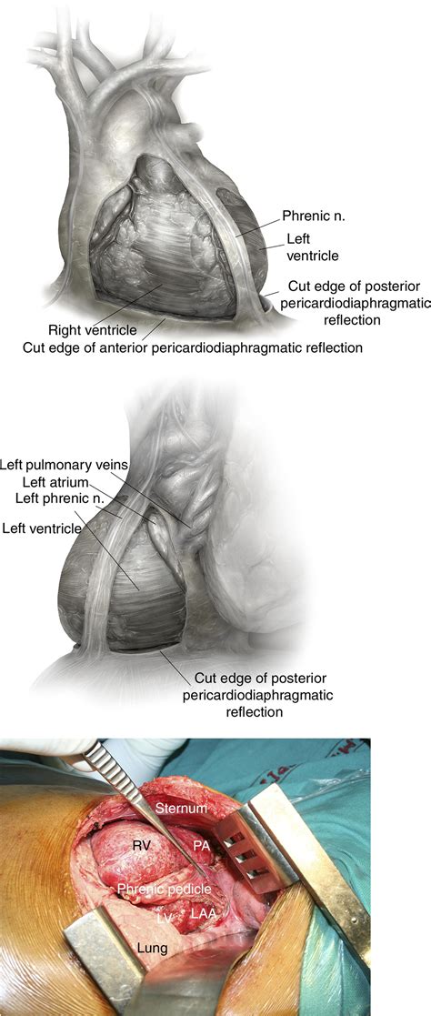 Pericardiectomy for Chronic Constrictive Pericarditis via Left Anterolateral Thoracotomy ...