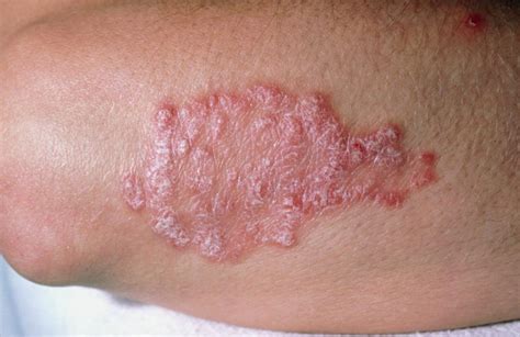 Psoriasis | Causes, Triggers, Diagnosis & Treatment