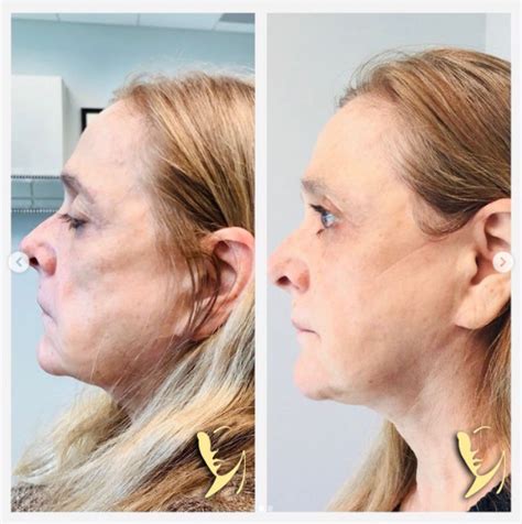 facial-fillers-sculptra-aesthetic-jawline-contouring | Robinson FPS