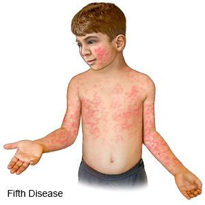 Erythema Infectiosum (Fifth Disease) - What You Need to Know