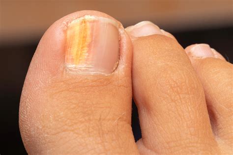 Causes of Yellow Toenails – Fungus Therapy – fungustherapy.com