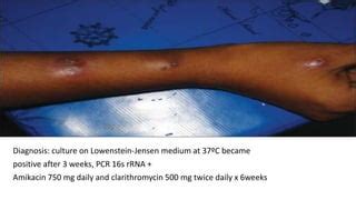 Atypical mycobacterial infections in dermatology