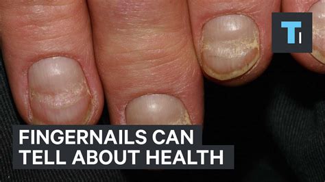 Fingernails can tell about health - YouTube