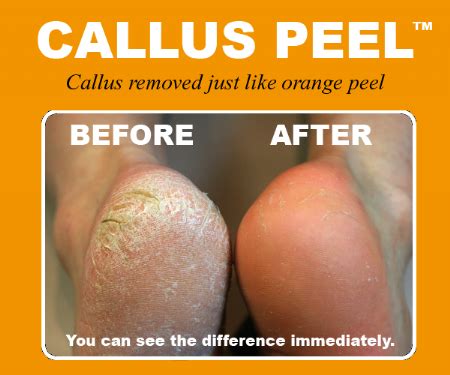 Callus Peel