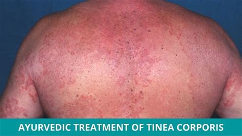 How to Treat Tinea Corporis in Ayurveda?