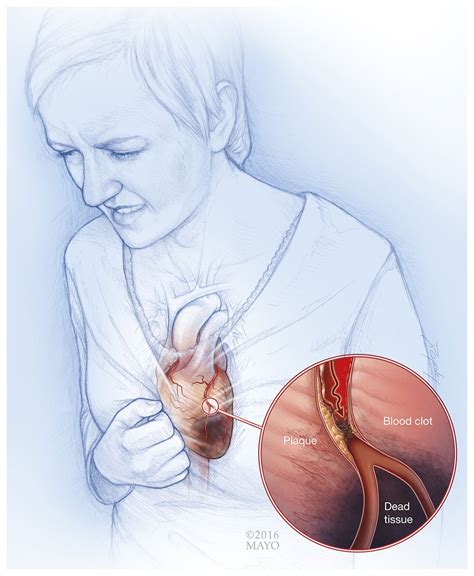 Cardiovascular Disease & Smoking | Guides & Tools | BecomeAnEX