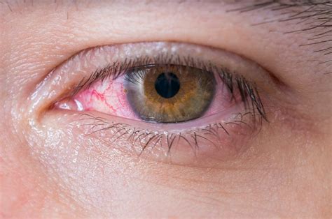 Xeroftalmia o conjuntivitis seca: qué es, causa y cómo tratarla