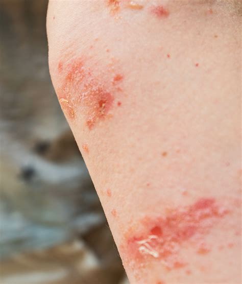 Poison Ivy Poison Sumac — PC Dermatology General Surgical Dermatology ...