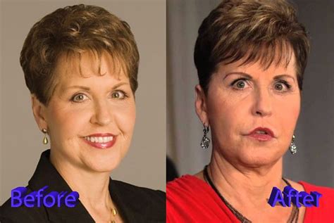 Joyce Meyer Plastic Surgery Before and After