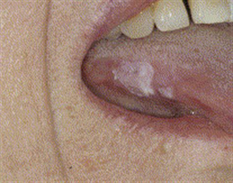 Morsicatio Mucosae Oris—A Chronic Oral Frictional Keratosis, Not a Leukoplakia - Journal of Oral ...