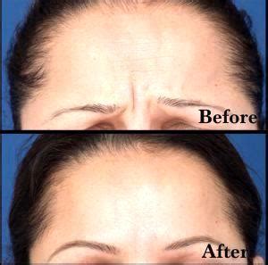 Botox 11 Lines Before & After » Facial Injections: Info, Prices, Photos ...